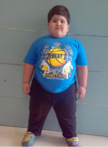 印度肥胖症男孩4岁重88斤 胃切除手术后成功瘦身