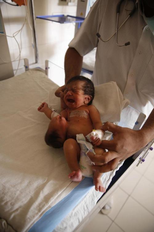 印度诞生双头女婴 “第二头颅”长在肚子上
