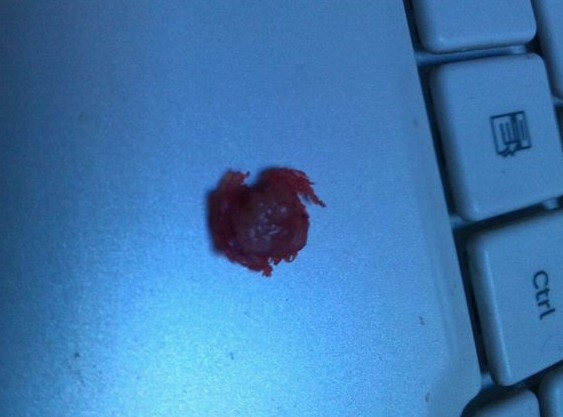 子弹是怎么取出来的 晕血勿入！