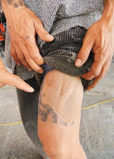 台湾男子烧伤脸 为救命将大腿刺青移植脸上
