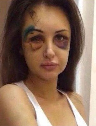 俄27岁女模与千万富翁男友分手遭暴打变猪头