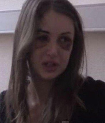 俄27岁女模与千万富翁男友分手遭暴打变猪头