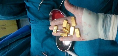印度富商肚中藏12根金条 就医取出被没收